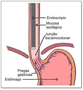 endoscopia digestiva alta
